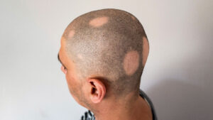 Alopecia Article 1661414285